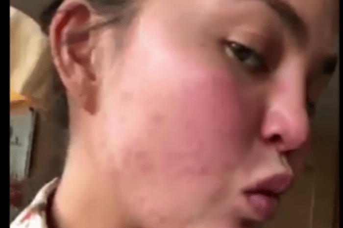 Chrissy Teigen's Face Rash Goes Viral, Gets Meme Treatment