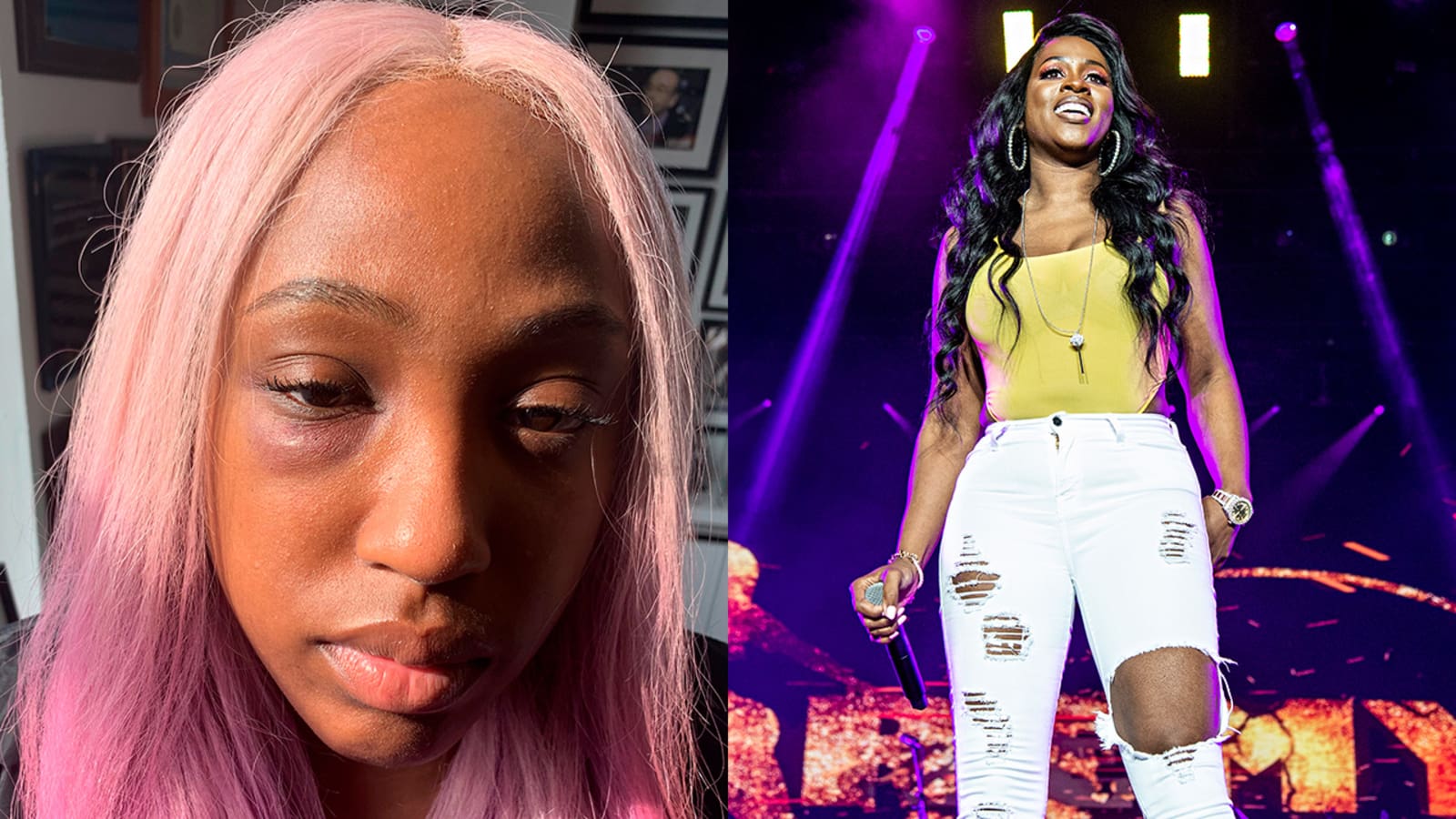 Brittney Taylor Shows Her Black Eye After Claiming Remy Ma Punched Her - See The Photo