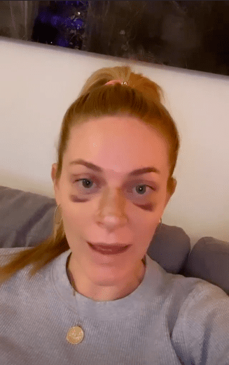 Leah McSweeney Clears Things Up About Her Bruised Eyes – Shares Post ...