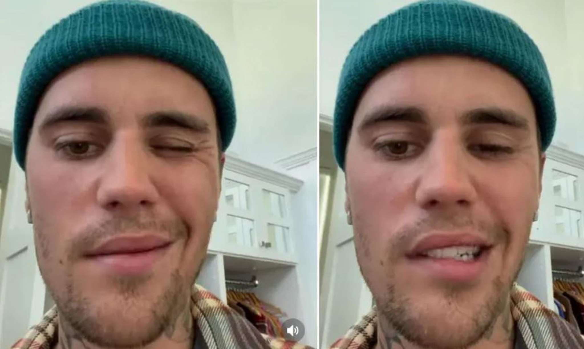 cant-smile-and-blink-with-one-eye-28-year-old-justin-bieber-paralyzed-half-of-his-face